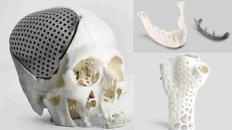 3D printing helps save newborns with skull defects