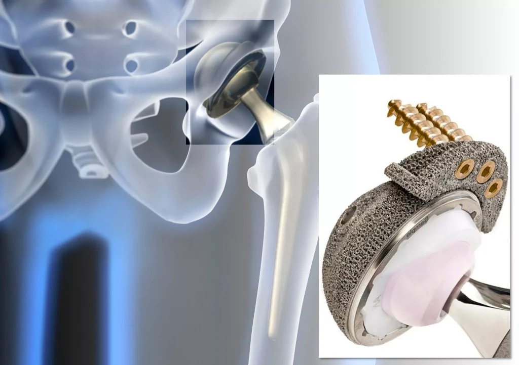 Metal 3D Printing Medical Metal Hip Implants